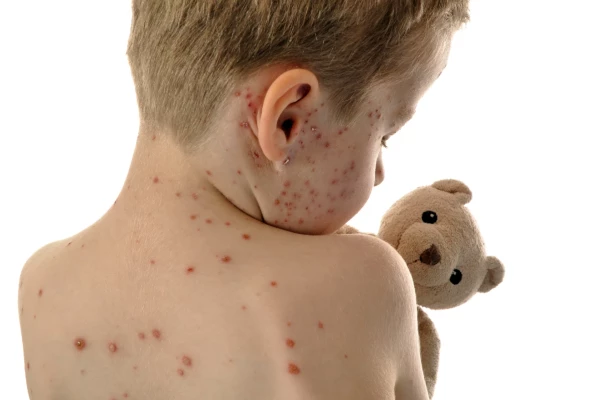 Image for article titled Measles Risk 