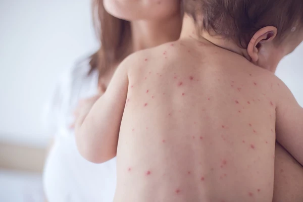 Image for article titled Measles - What do you need to know?